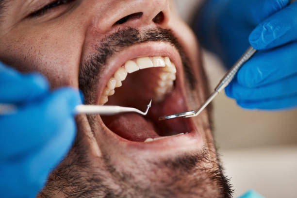 Best Emergency Wisdom Teeth Removal in Fulton, MS