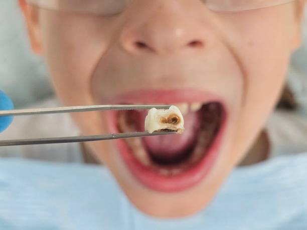 Best Emergency Root Canal Treatment in Fulton, MS
