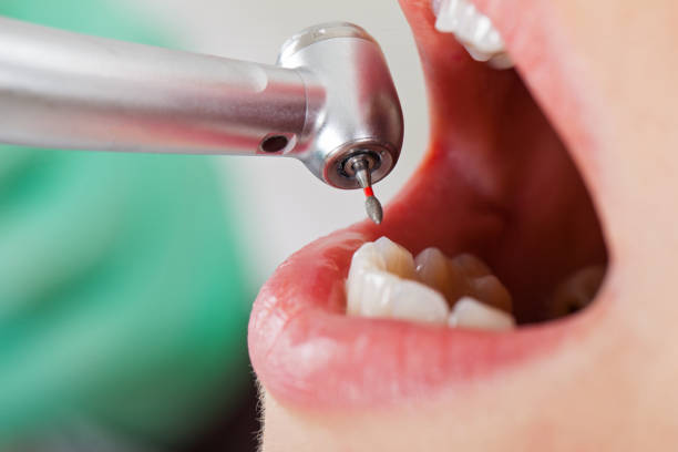 Best Emergency Tooth Extraction in Fulton, MS